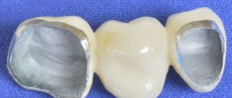 Metal-ceramic crowns