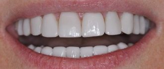 Коронки на передних зубах