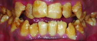 Cosmetic enamel restorations: natural biomimetic layering technique