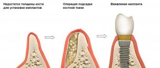 Костная пластика