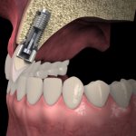 Bone material for sinus lift: literature review