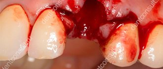 bleeding after tooth extraction