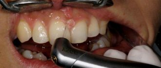 Treatment of gum fibromatosis