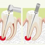 Treatment of dental granuloma