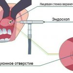 Лечение кисты верхнечелюстной пазухи