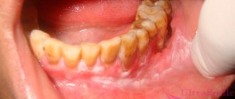 leukoplakia