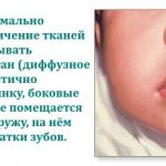 макроглоссия у новорожденных