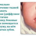 macroglossia in newborns