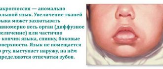 macroglossia in newborns