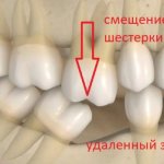 Methods for correcting the Popov-Godon phenomenon