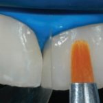 Treatment methods for fused teeth