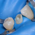 Методы реставрации зубов