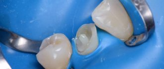 Dental restoration methods