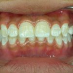 Microabrasion of tooth enamel