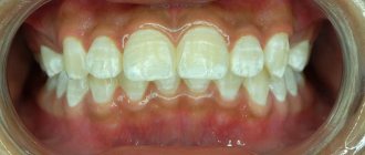 Microabrasion of tooth enamel