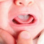 Молочница у детей во рту