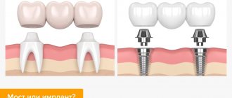 Bridge or implant in pictures