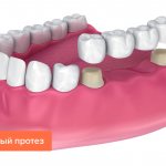 Мостовидный протез зубов в картинках