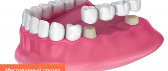 Мостовидный протез зубов в картинках