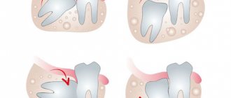 Is it possible to remove wisdom teeth when installing braces?