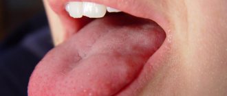 callus on tongue