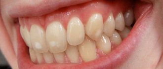 Initial stage of caries