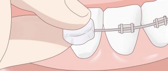 Applying orthodontic wax to braces.