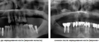 bone tissue augmentation before and after photos