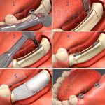 Bone tissue augmentation before implantation by cutting the alveolar process