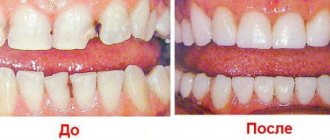 Teeth extension before and after