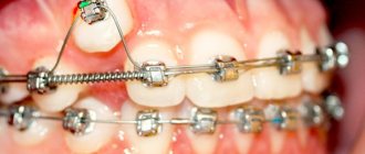 External braces are one of the main (for now) methods of orthodontic treatment for correcting malocclusion in adults.