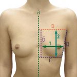 Necessary measurements when choosing implants