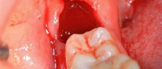 Is it normal if your mouth does not open after wisdom tooth removal? How can I solve the problem? 
