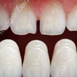 grinded teeth and selection of veneer colors