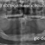 Очень часто при планировании восстановления зубов с использованием имплантатов мы сталкиваемся с дефицитом костной ткани