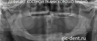 Очень часто при планировании восстановления зубов с использованием имплантатов мы сталкиваемся с дефицитом костной ткани