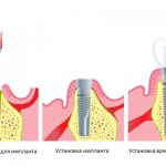 One-stage implantation