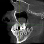 Odontogenic cyst on x-ray