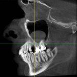 Odontogenic formation on x-ray