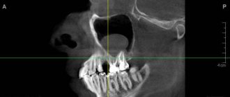 Odontogenic formation on x-ray