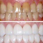 Description of veneers