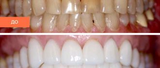 Description of veneers