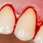 The main causes of bleeding gums