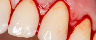 The main causes of bleeding gums