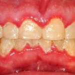 Acute catarrhal gingivitis