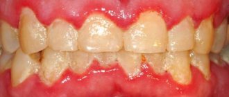 Acute catarrhal gingivitis