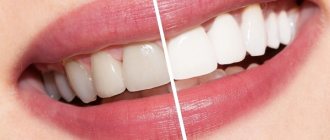 Whitening before and after