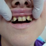 Absence of upper incisors