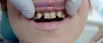 Absence of upper incisors