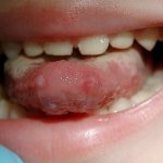 Burn of the oral cavity in a child.